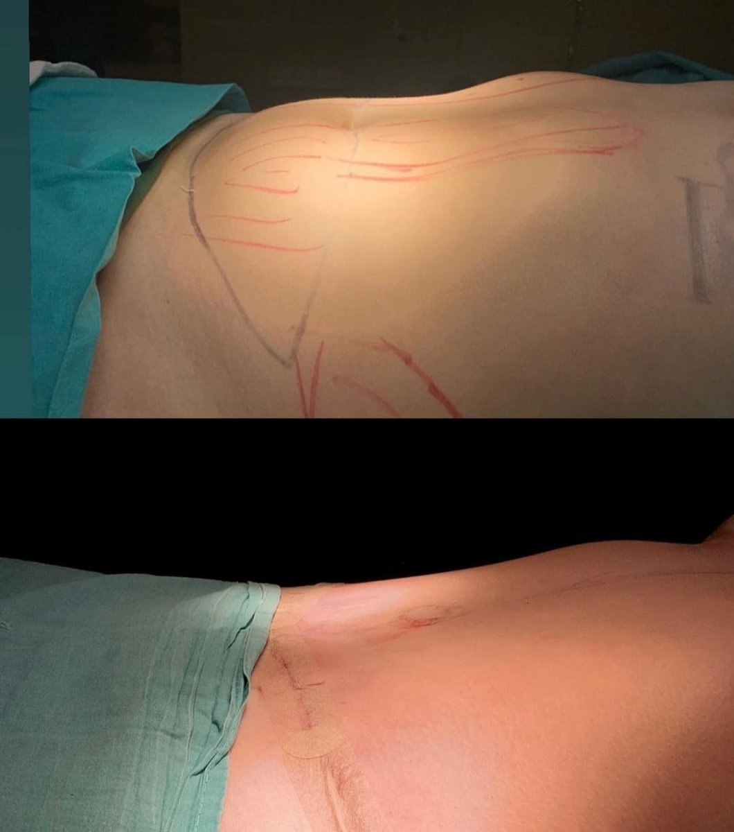 Before and after result by Dr. Ali Can Gunenc
