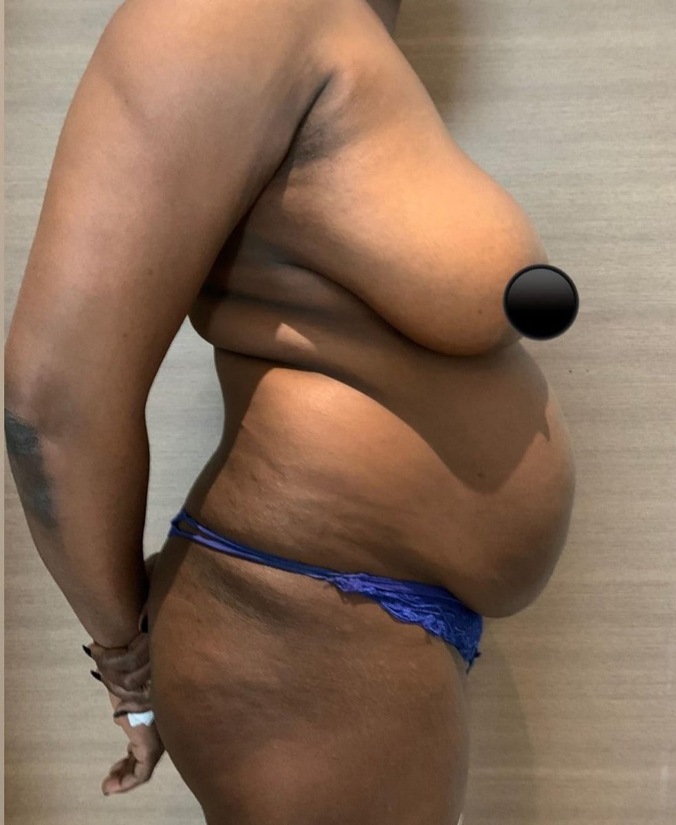 Before and after result by Dr. Ali Can Gunenc