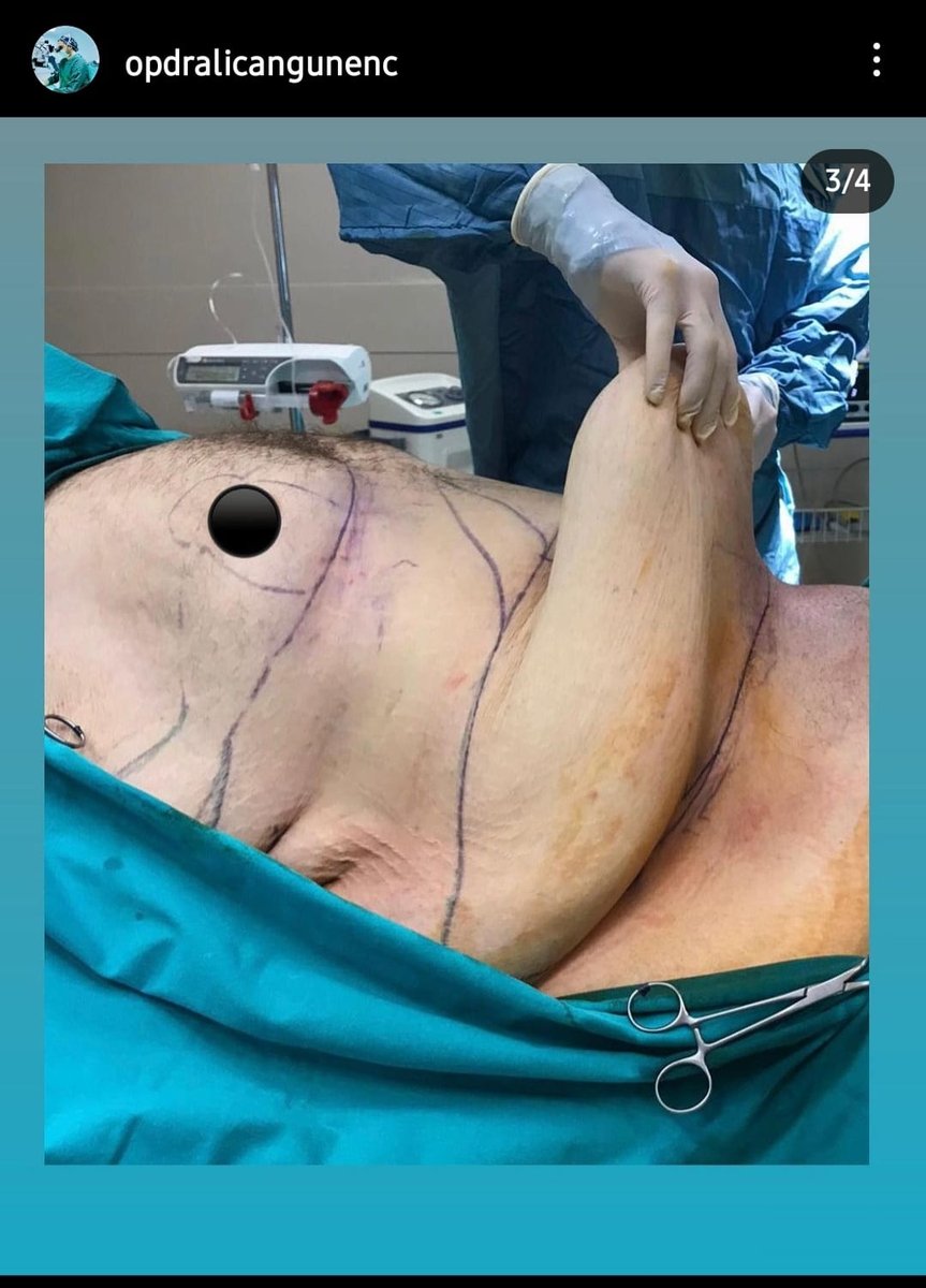 Before and after result by Dr. Ali Can Gunenc