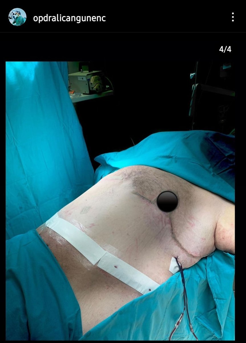 Before and after result by Dr. Ali Can Gunenc