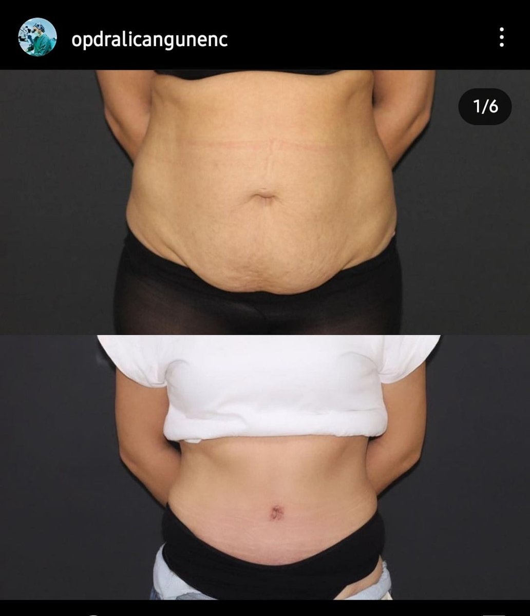 Before and after result by Dr. Ali Can Gunenc