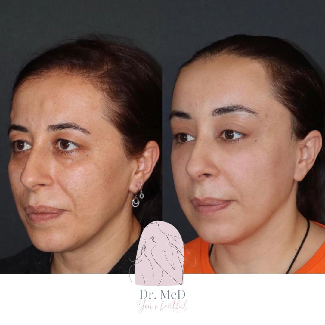 Before and after result by Dr. Aykut Gok