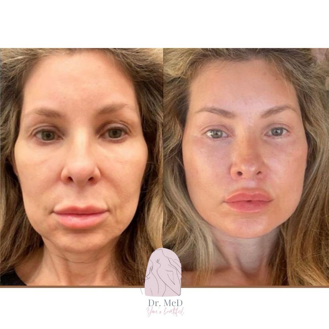 Before and after result by Dr. Aykut Gok