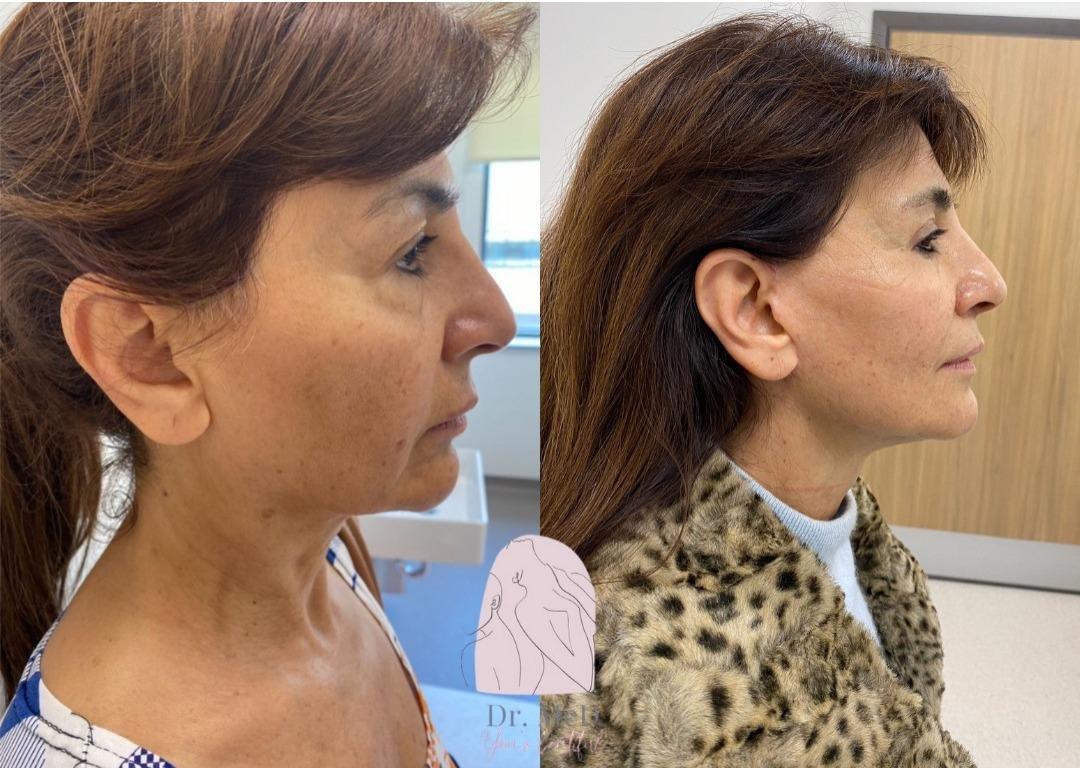 Before and after result by Dr. Aykut Gok
