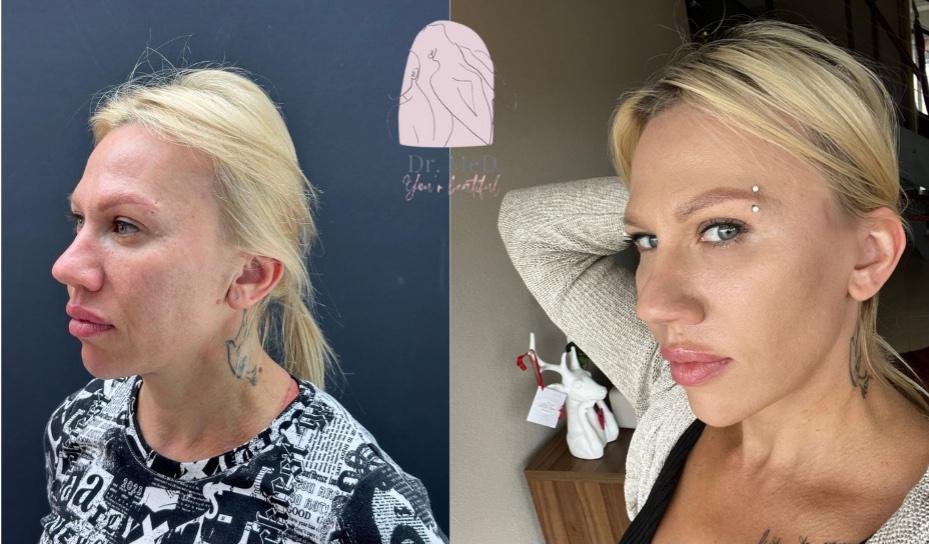 Before and after result by Dr. Aykut Gok