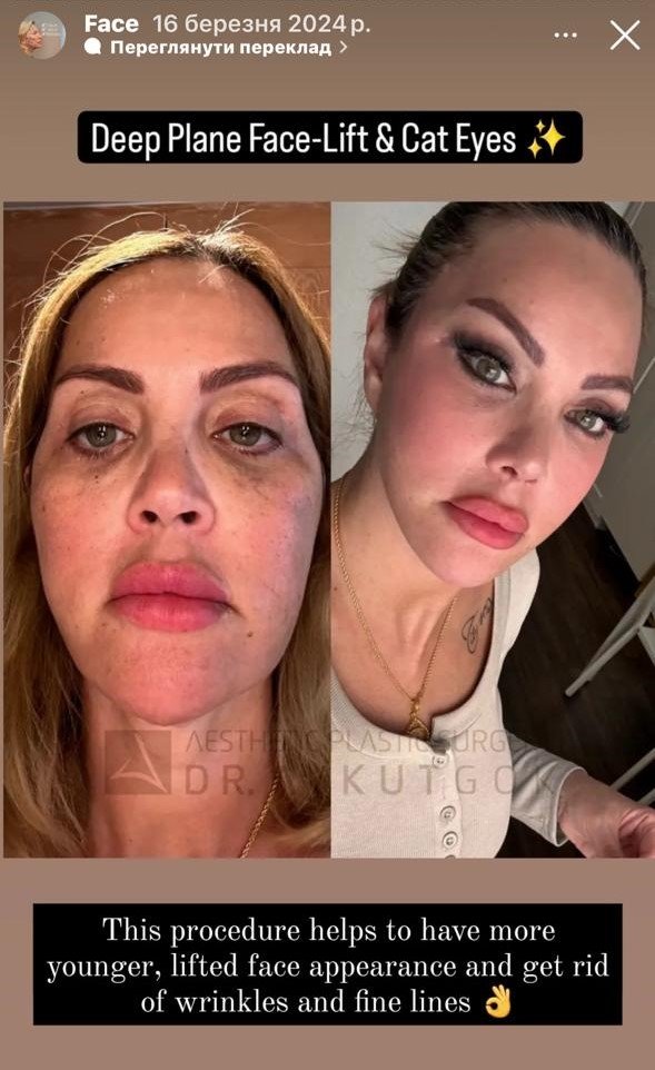 Before and after result by Dr. Aykut Gok