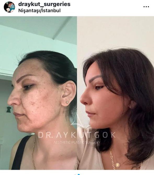 Before and after result by Dr. Aykut Gok