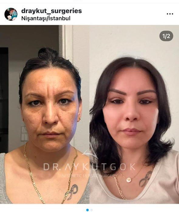 Before and after result by Dr. Aykut Gok