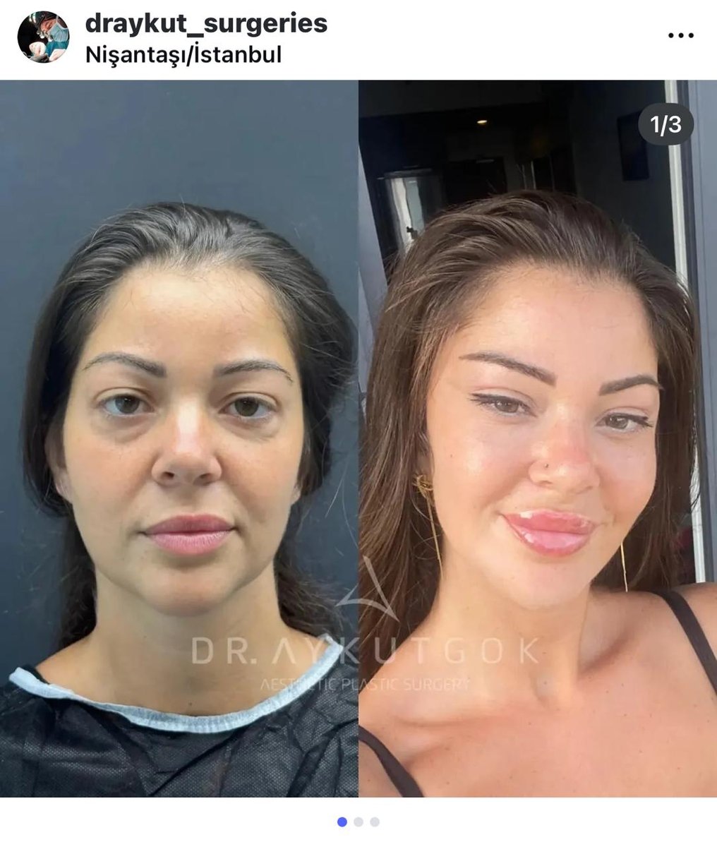 Before and after result by Dr. Aykut Gok