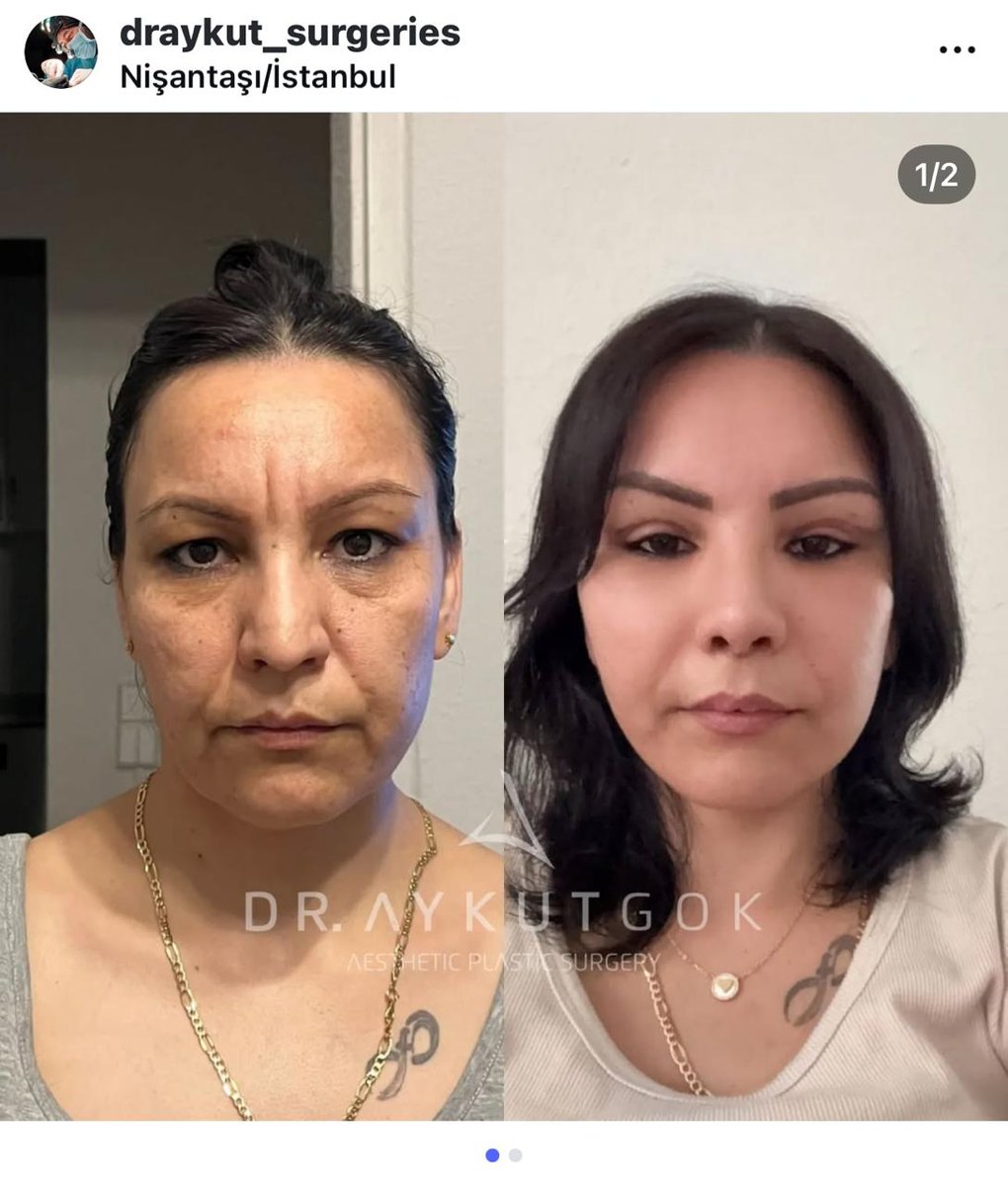 Before and after result by Dr. Aykut Gok