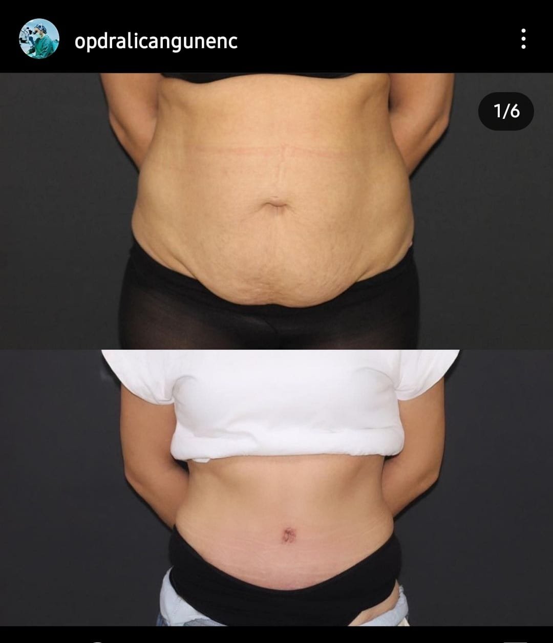 Before and after result by Dr. Ali Can Gunenc