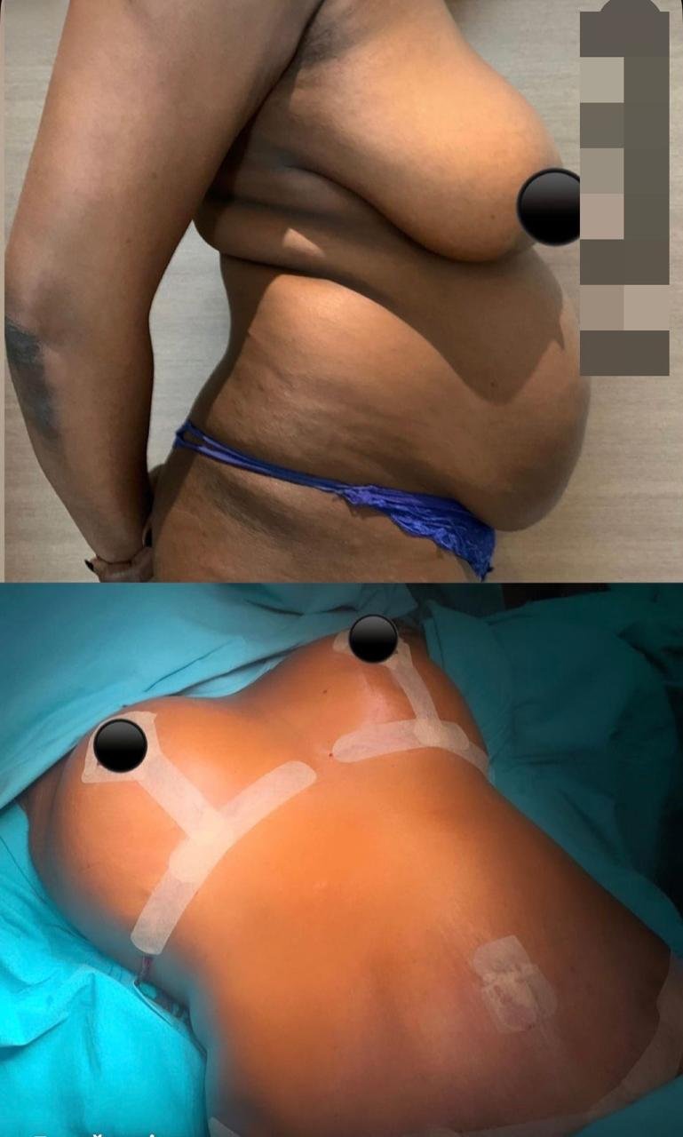 Before and after result by Dr. Ali Can Gunenc