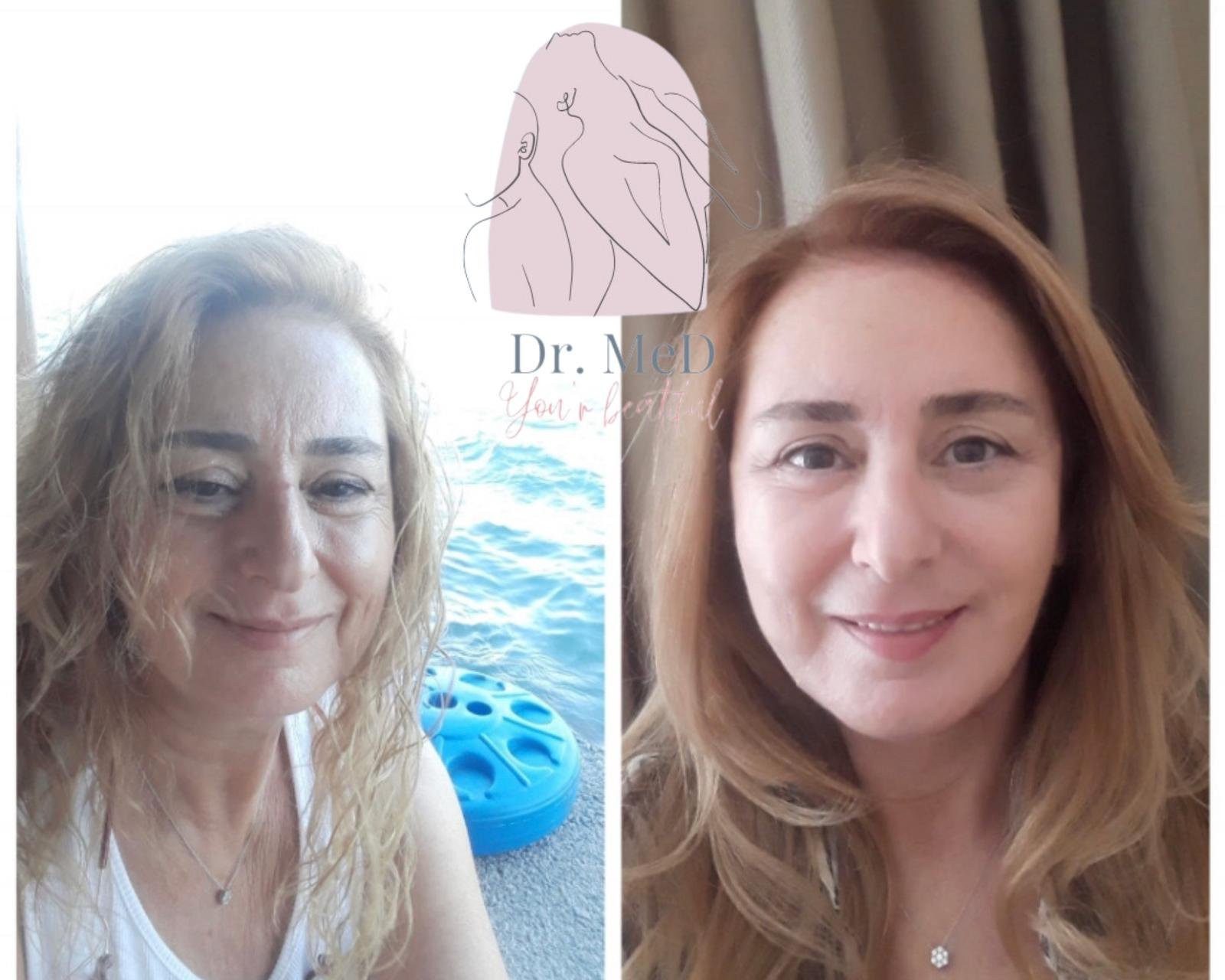 Before and after result by Dr. Aykut Gok