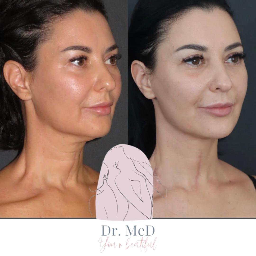 Before and after result by Dr. Aykut Gok