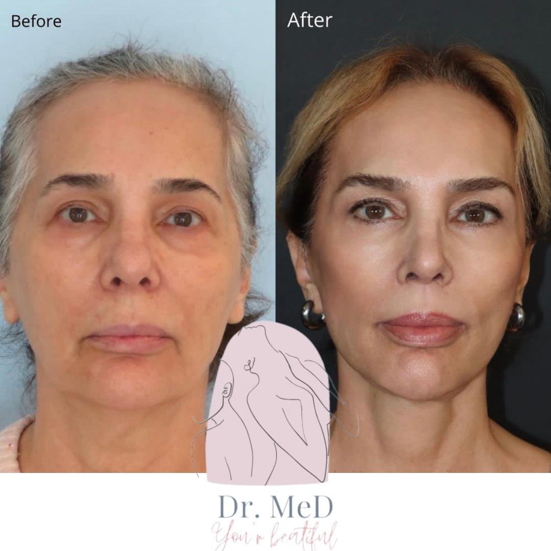 Before and after result by Dr. Aykut Gok
