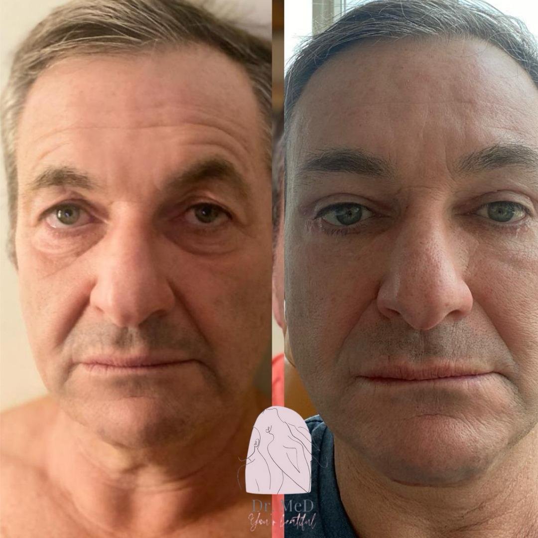Before and after result by Dr. Aykut Gok
