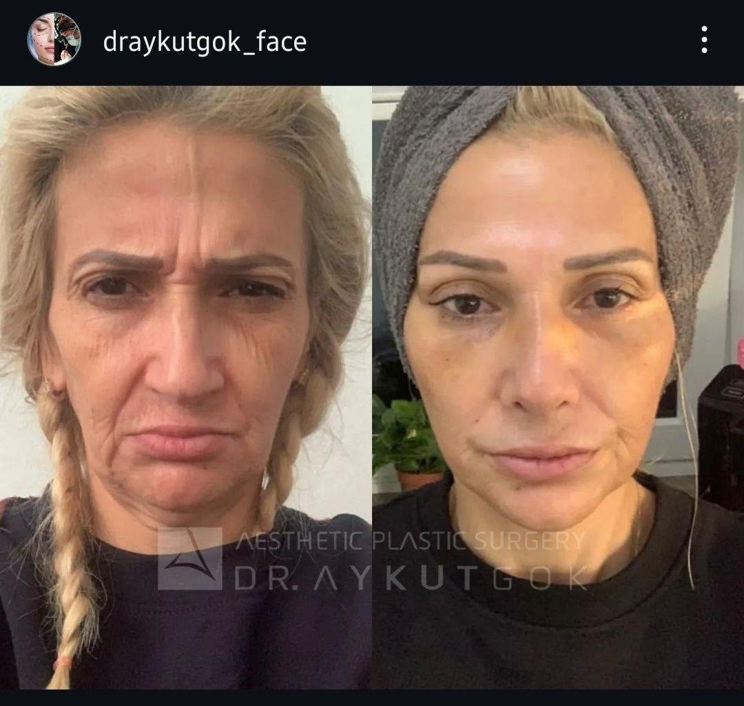 Before and after result by Dr. Aykut Gok