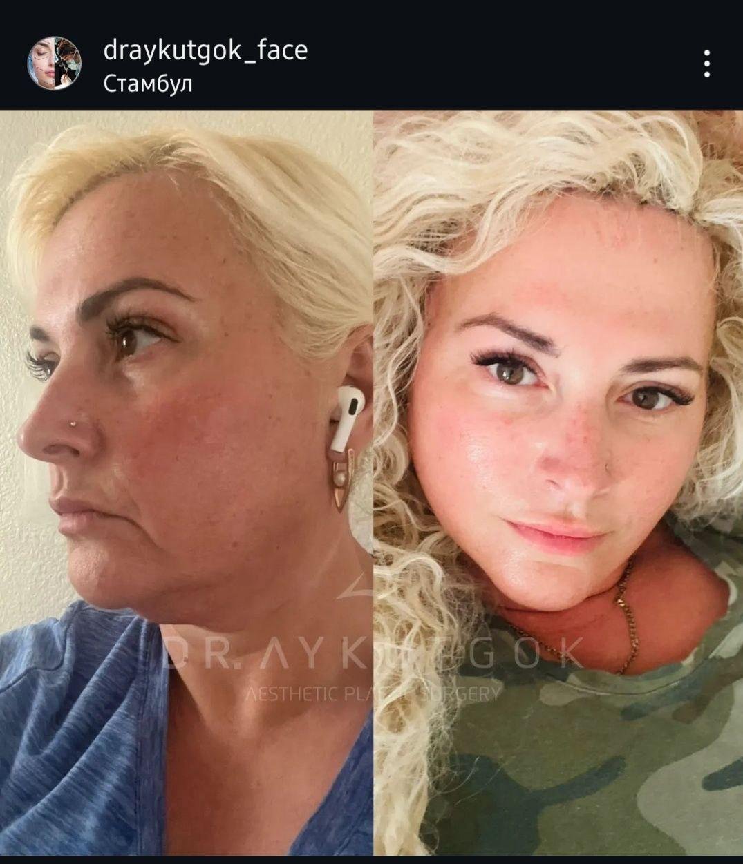Before and after result by Dr. Aykut Gok