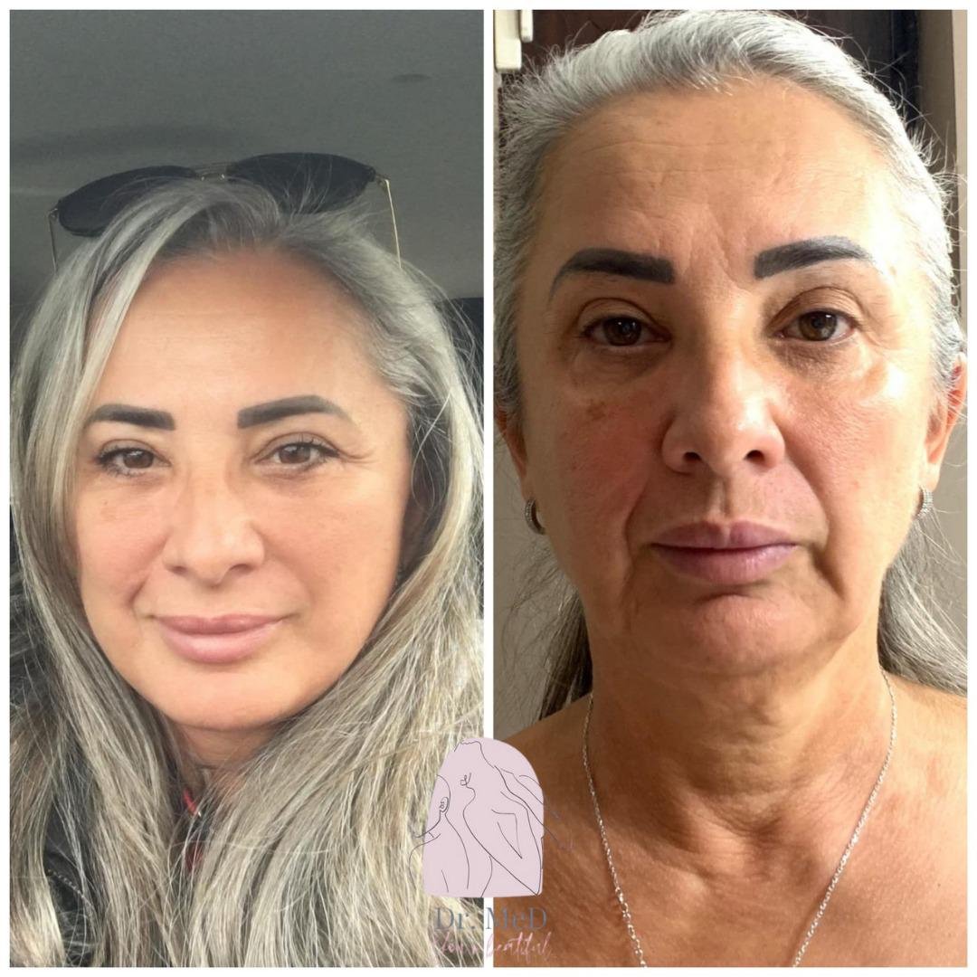 Before and after result by Dr. Aykut Gok