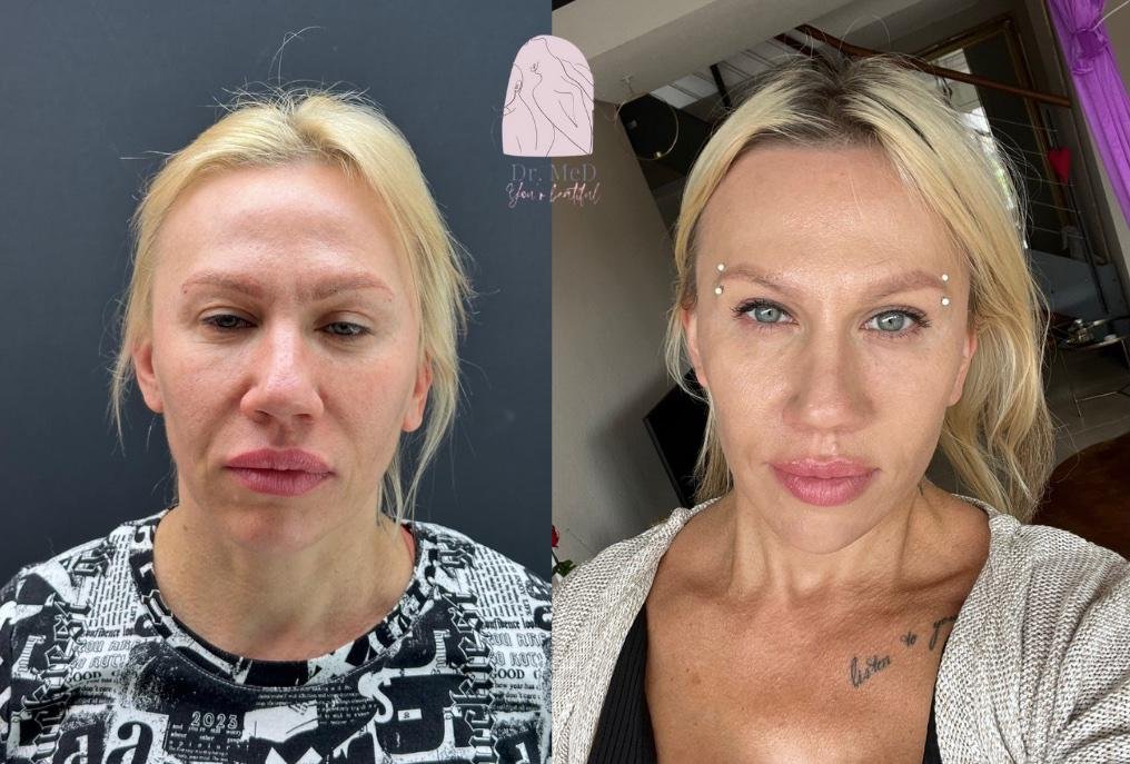 Before and after result by Dr. Aykut Gok