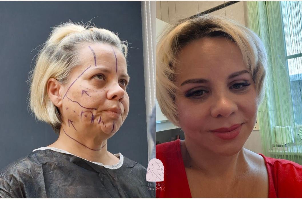 Before and after result by Dr. Aykut Gok