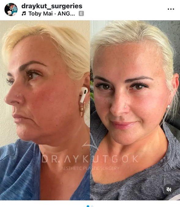 Before and after result by Dr. Aykut Gok