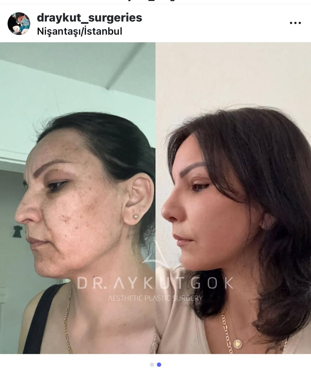 Before and after result by Dr. Aykut Gok