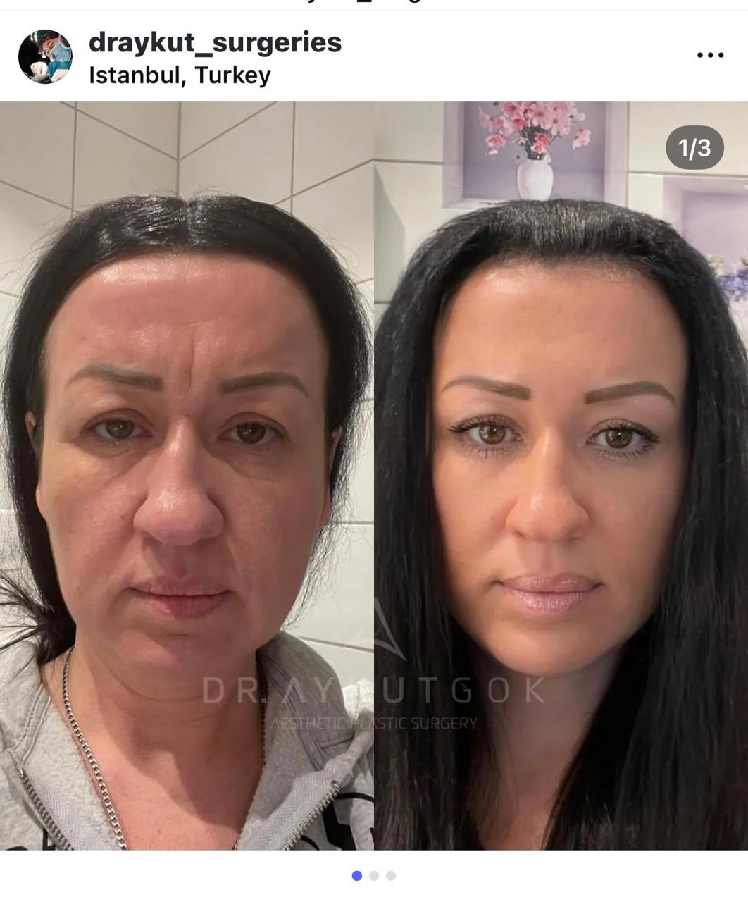 Before and after result by Dr. Aykut Gok