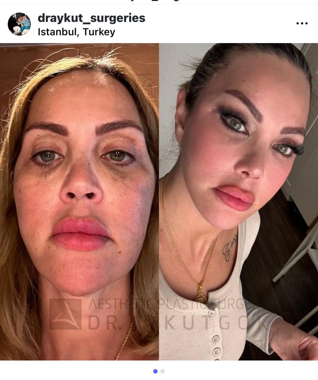 Before and after result by Dr. Aykut Gok