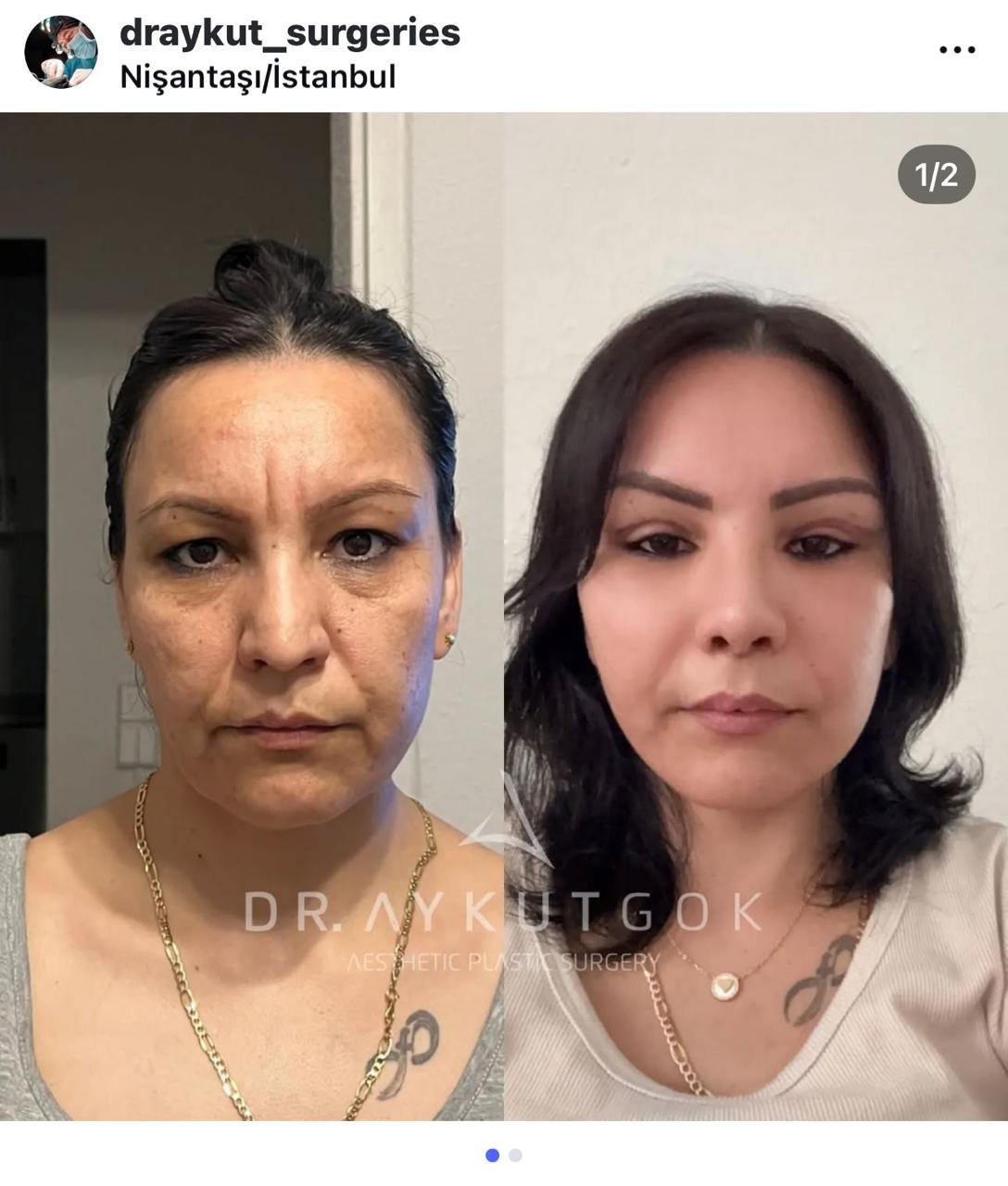 Before and after result by Dr. Aykut Gok