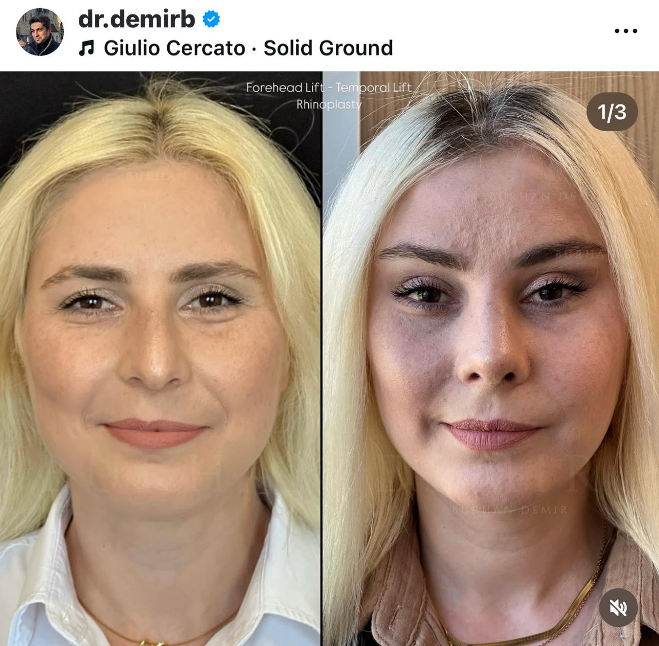 Before and after result by Dr. Burhan Demir