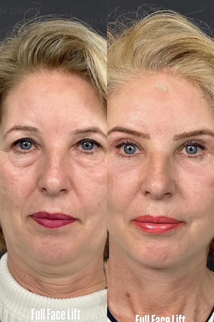 Before and after result by Dr. Burhan Demir