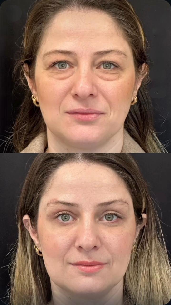Before and after result by Dr. Burhan Demir