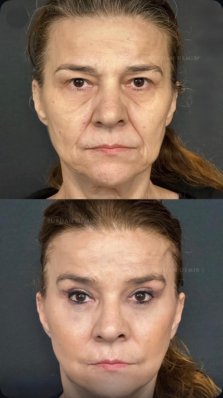 Before and after result by Dr. Burhan Demir