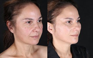 Before and after result by Dr. Cenk Şen