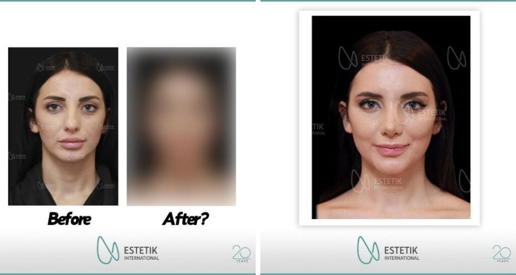 Before and after result by Dr. Cenk Şen