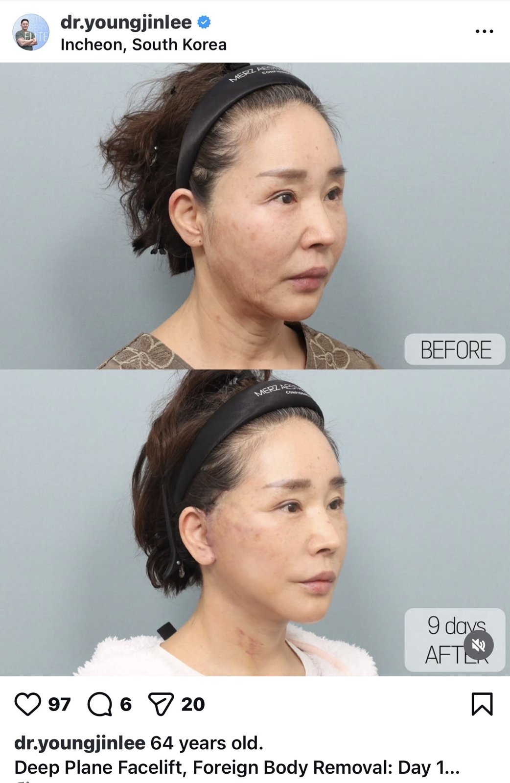 Before and after result by Dr. Young Jin Lee