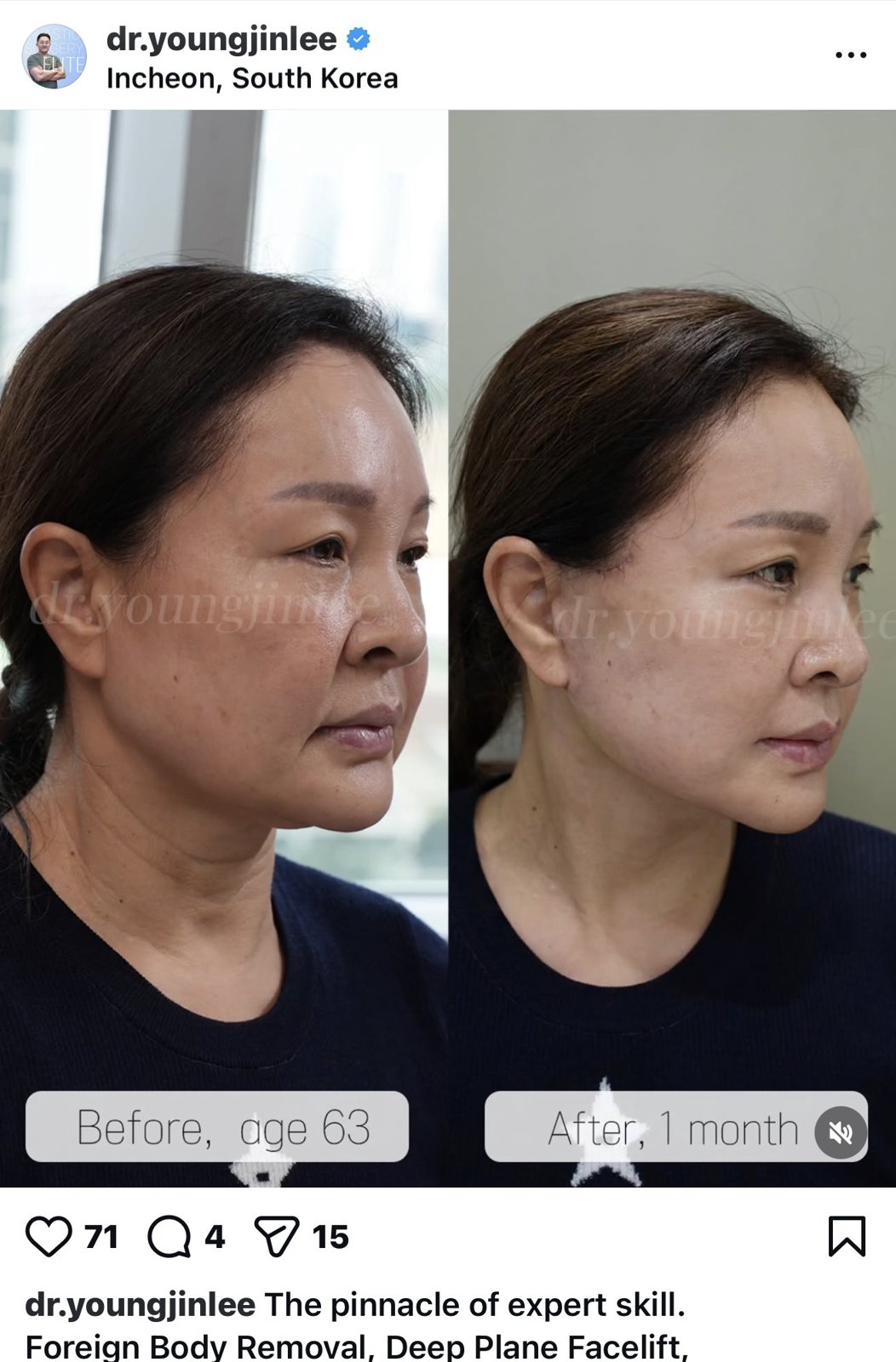 Before and after result by Dr. Young Jin Lee