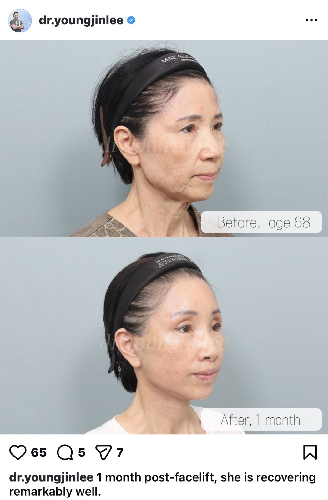 Before and after result by Dr. Young Jin Lee