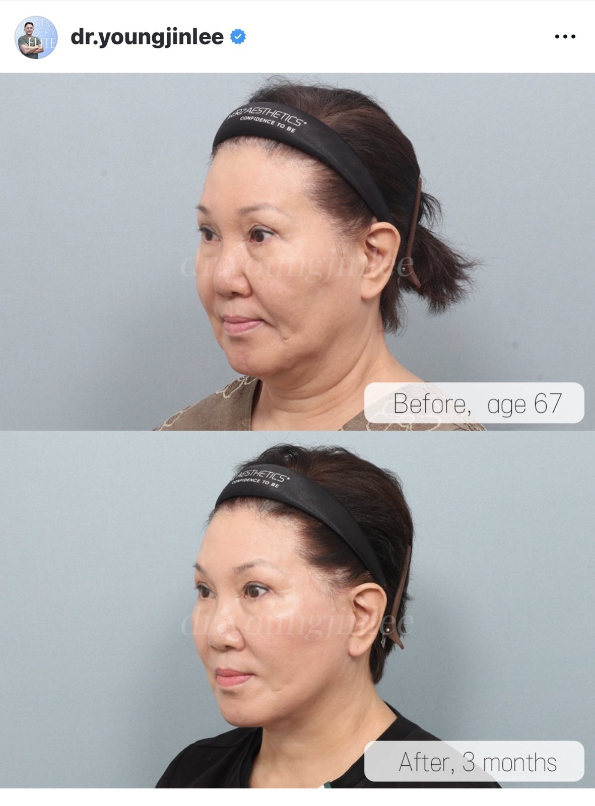 Before and after result by Dr. Young Jin Lee