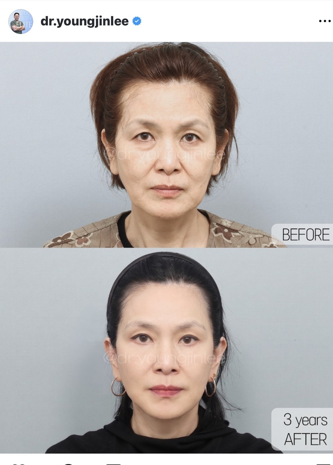 Before and after result by Dr. Young Jin Lee