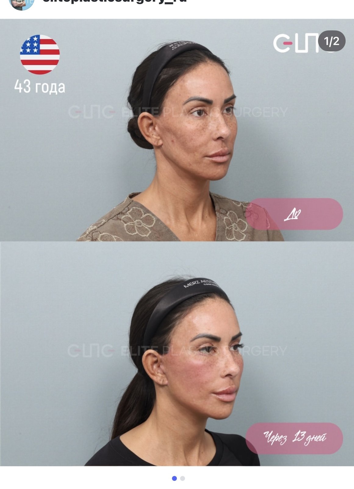 Before and after result by Dr. Young Jin Lee