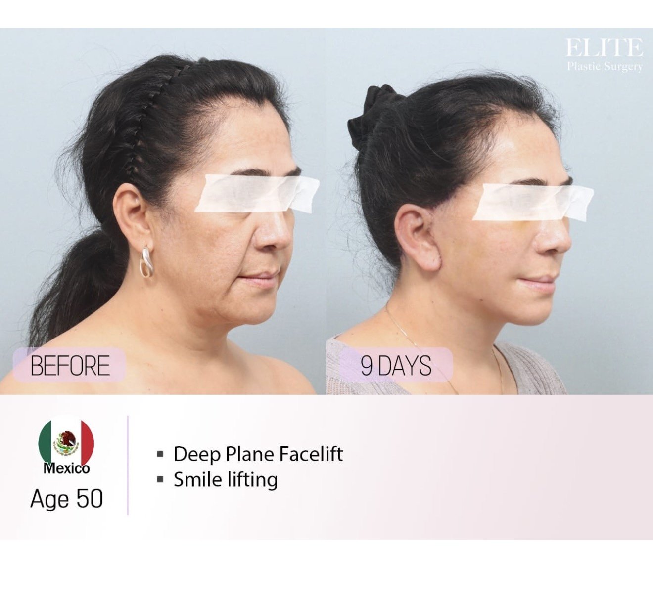 Before and after result by Dr. Young Jin Lee