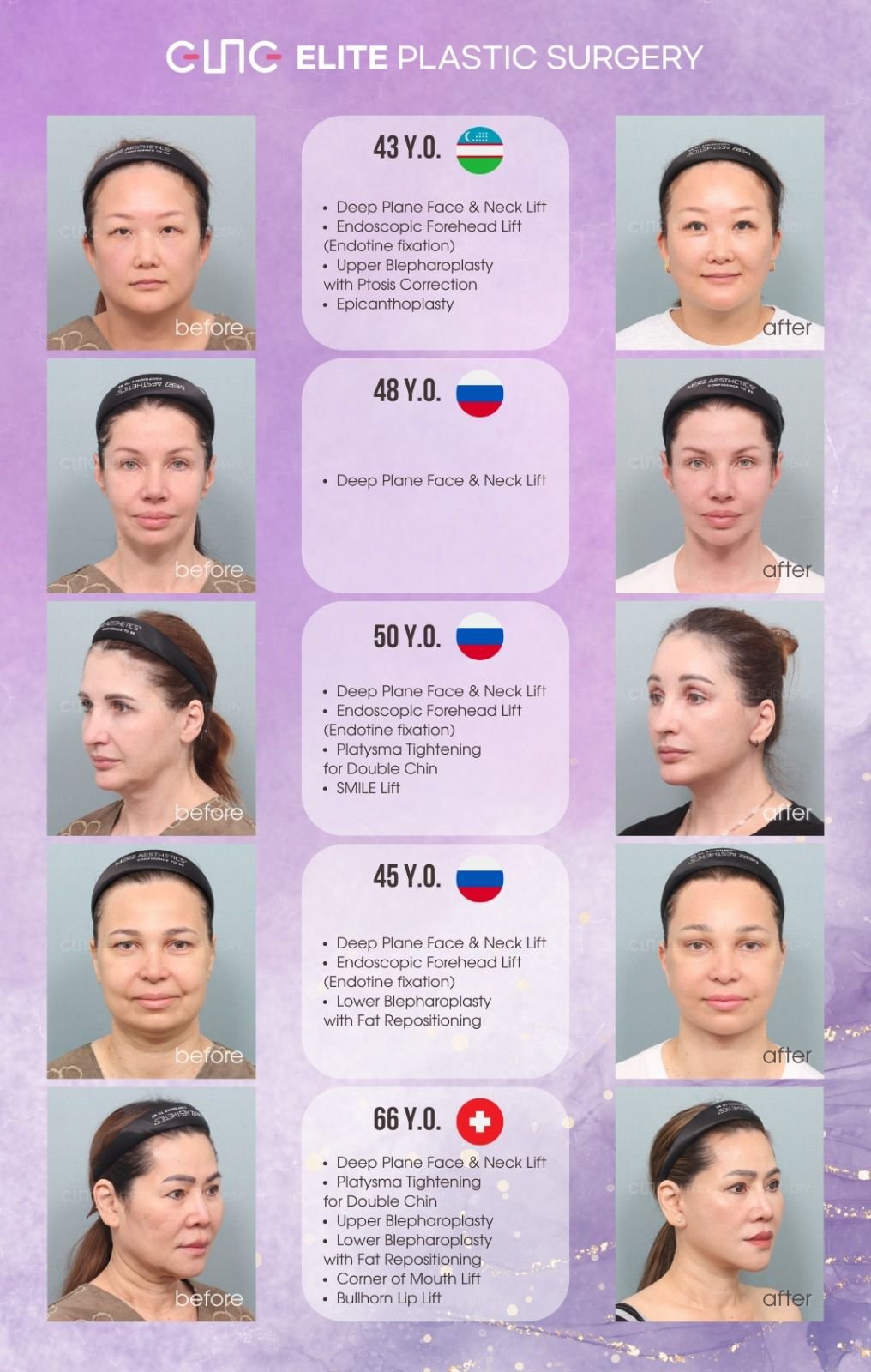 Before and after result by Dr. Young Jin Lee