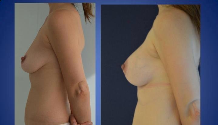 Before and after result by Dr. Ergin Er