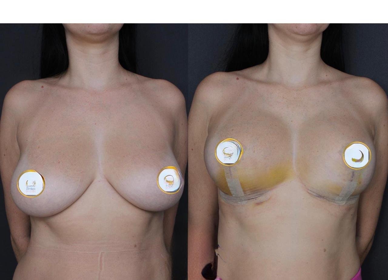 Before and after result by Dr. Ergin Er