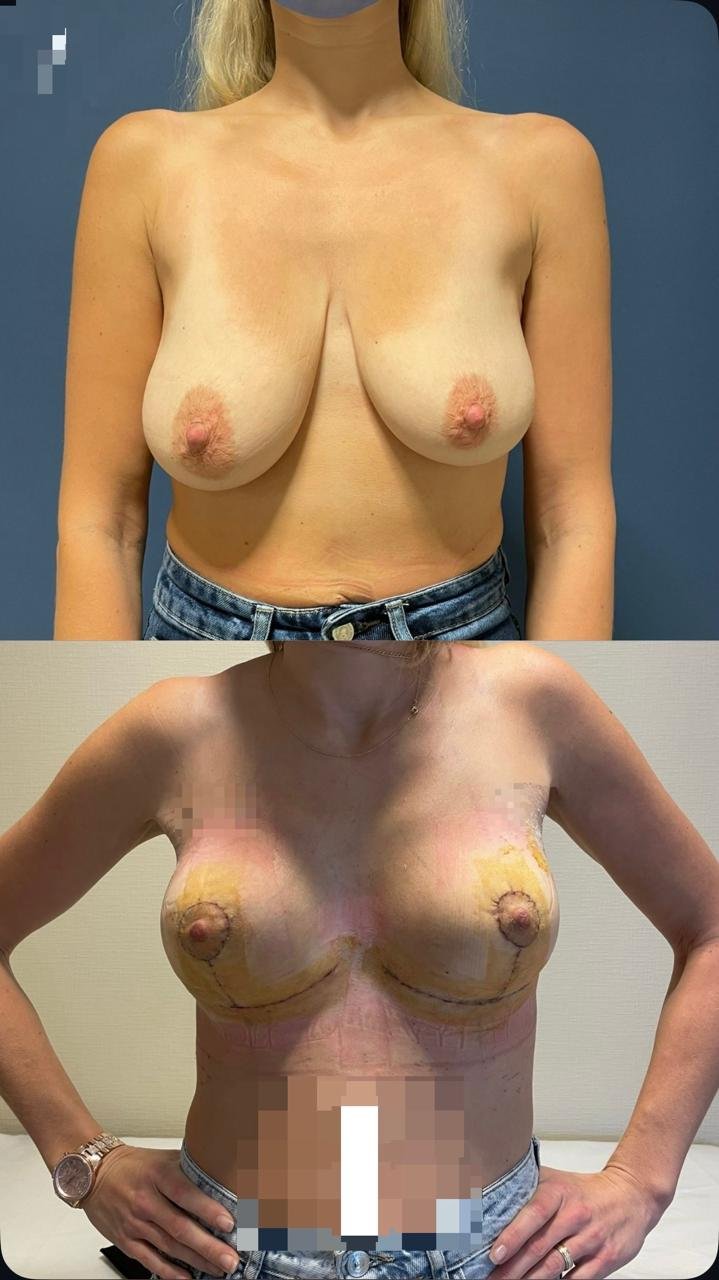 Before and after result by Dr. Ergin Er