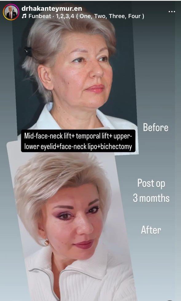 Before and after result