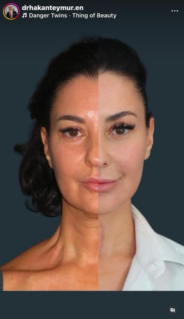 Before and after result
