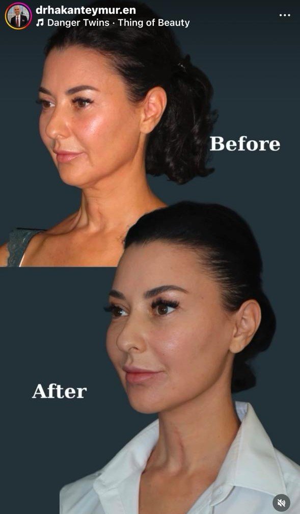 Before and after result